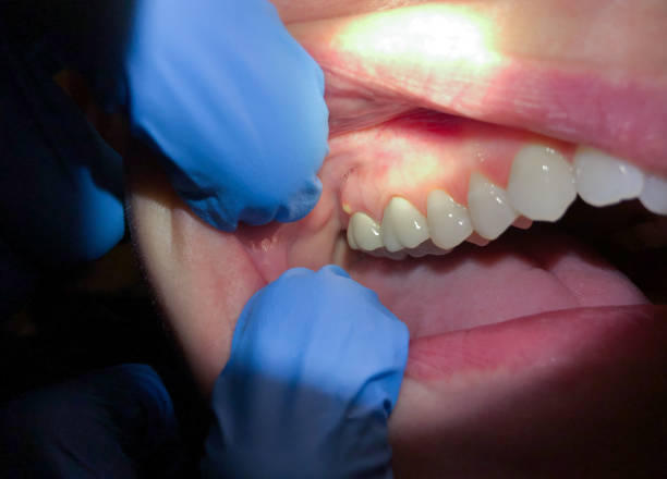Best Emergency Dental Care for Abscessed Tooth in Colmar Manor, MD
